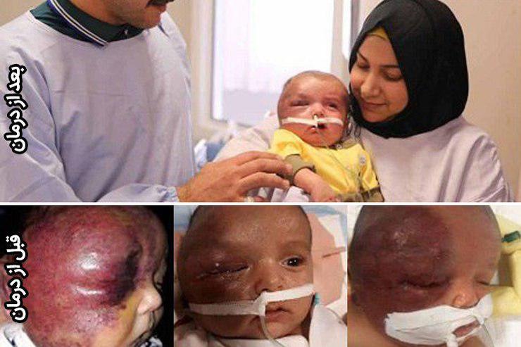 یک کودک دوماهه عراقی مبتلا به کازاباخ‌مریت که یک سندروم نادر و کشنده است، به دست پزشکان ایرانی در بیمارستان رضوی نجات یافت.