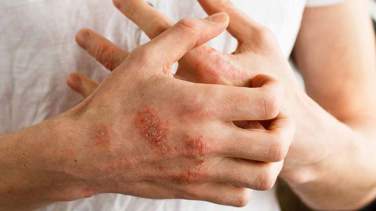 متخصص پوست و مو گفت: داروهای حاوی آنتی‌هیستامین روش مناسبی برای تسکین علائم آلرژیک در فصل بهار هستند، اما استفاده خودسرانه از آن توصیه نمی‌شود، زیرا همه آن‌ها را نمی‌توان طولانی‌مدت مصرف کرد.