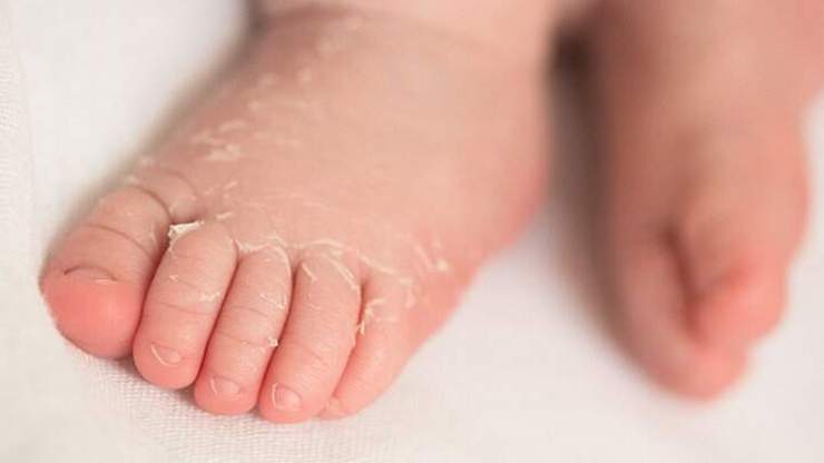 کاوازاکی چیست؛ همه چیز درباره این بیماری و ارتباطش با کرونا