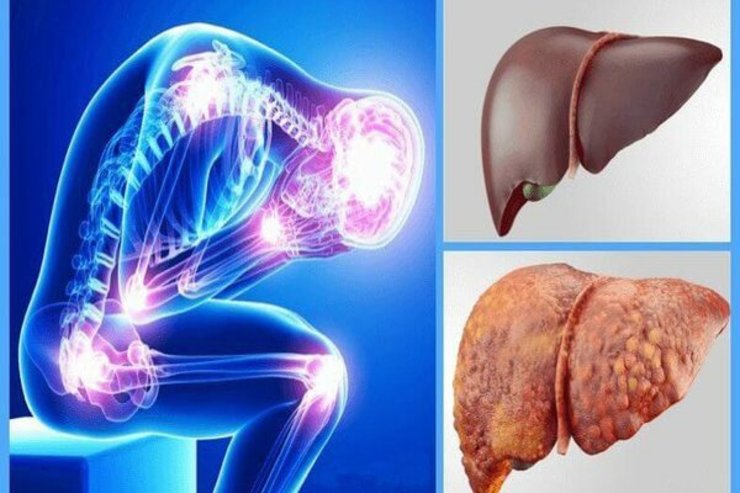 پیشگیری و راهکار‌های درمان و تشخیص کبد چرب