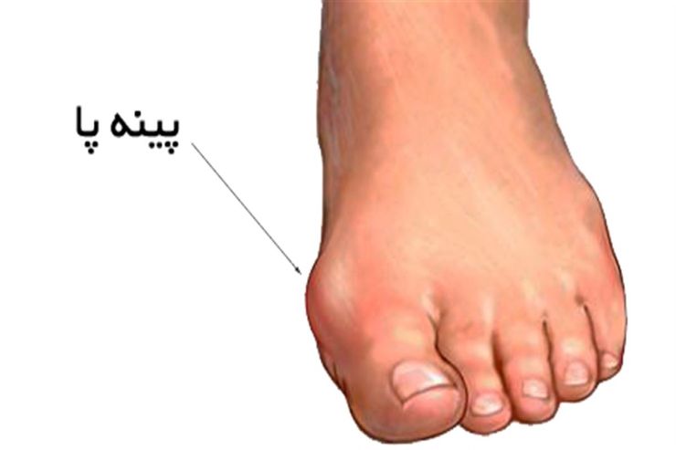 کارشناس ارشد آسیب شناسی و حرکت اصلاحی گفت: پهن شدن و پینه بستن در ناحیه داخلی پا نشانه‌های بارز کف پای صاف هستند.