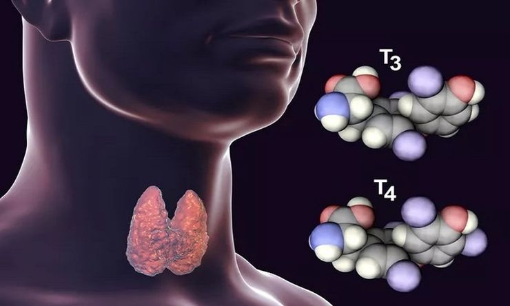 تیروئیدیت هاشیموتو (Hashimoto’s Thyroiditis) نوعی التهاب مزمن غده تروئید است که در آن سیستم ایمنی بدن به دلیل بیماری خودایمنی به تیروئید حمله کرده و باعث تخریب بافت آن می‌شود. در نتیجه آن، فرد دچار کم کاری تیروئید می‌شود.