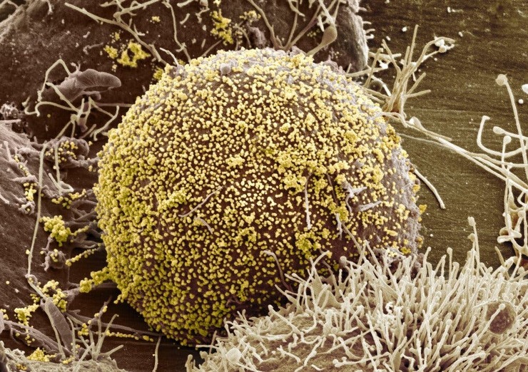 پزشکان آمریکایی موفق شده‌اند یک زن مبتلا به HIV را با سلول‌هایی بنیادی در خون بند ناف درمان کنند.