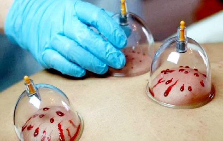 حجامت در طب سنتی عمدتا در بیماران قلبی وعروقی با هدف کاهش غلظت خون انجام می‌گرفت.