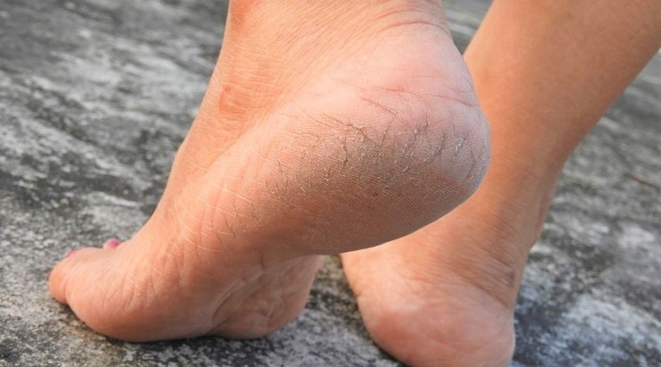امروزه با افزایش بهداشت و مراقبت‌های پوستی بازهم شاهد ترک پاشنه پا هستیم که به دغدغه‌ای برای افراد تبدیل شده است.