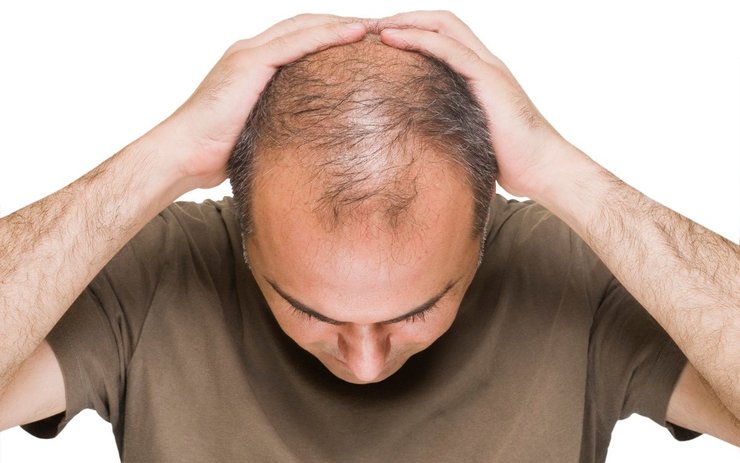 ریزش مو می‌تواند دلایل مختلفی داشته باشد عوامل وراثتی، هورمونی، استرس، زایمان در خانم‌ها، مصرف برخی داروها و تغذیه از جمله عواملی هستند که می‌توانند سبب ریزش مو شوند.