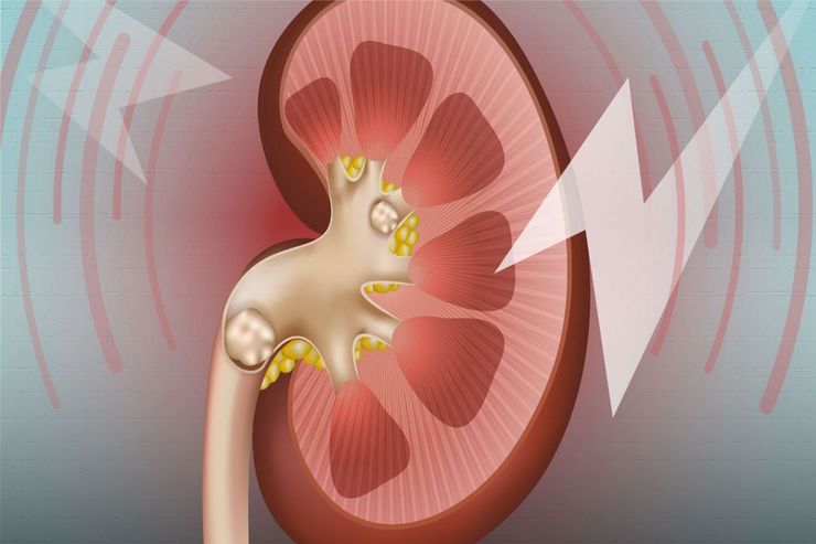 فوق تخصص کلیه گفت:‌ در افراد مبتلا به سنگ کلیه باید مصرف گوشت قرمز و پروتئین‌های حیوانی محدود باشند و از همه چیز مهم‌تر اینکه مصرف مایعات باید به حدی باشد که شخص بتواند روزی دو الی سه لیتر ادرار داشته باشد.