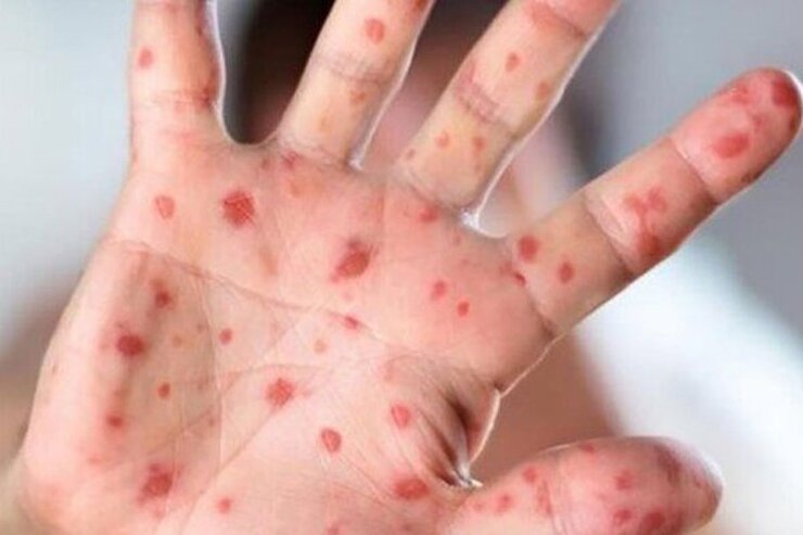 شناسایی ۱۳۲ بیمار مبتلا به سرخک در کشور| واکسیناسیون برای اتباع خارجی رایگان است