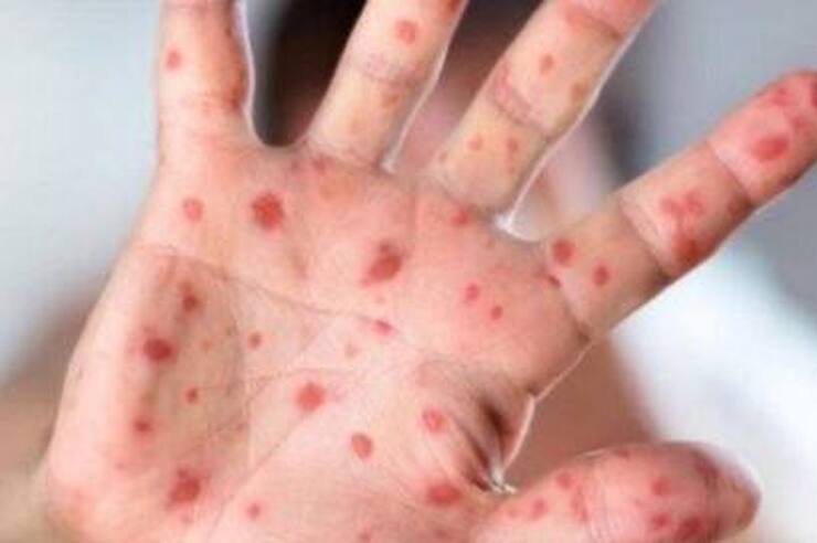 با طغیان سرخک در افغانستان و پاکستان و بروز دوباره این بیماریِ ریشه کن شده، وزارت بهداشت از واکسینه شدن بیش از یک میلیون مهاجر افغانستانی علیه بیماری سرخک و فلج اطفال در ایران خبرداد. 