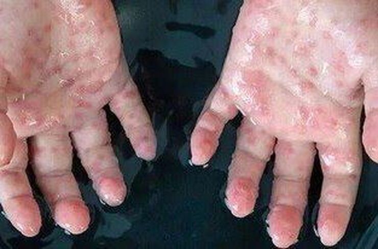 مدیرکل دفتر مدیریت بیماری‌های واگیر وزارت بهداشت گفت: تا کنون هیچ موردی از آبله میمون در کشور مشاهده نشده است.