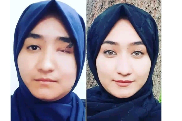 فاطمه یکی از زخمی‌های حمله به مرکز آموزشی کاج در کابل با کسب ۳۱۳ نمره در رشته مهندسی کامپیوتر دانشگاه کابل قبول شد.