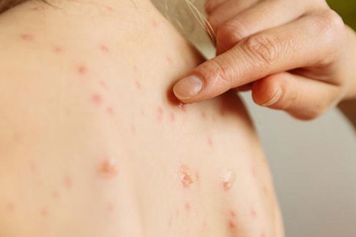 شمار مبتلایان به سرخک امسال خراسان رضوی نسبت به پارسال ۲.۵ برابر افزایش یافته است.