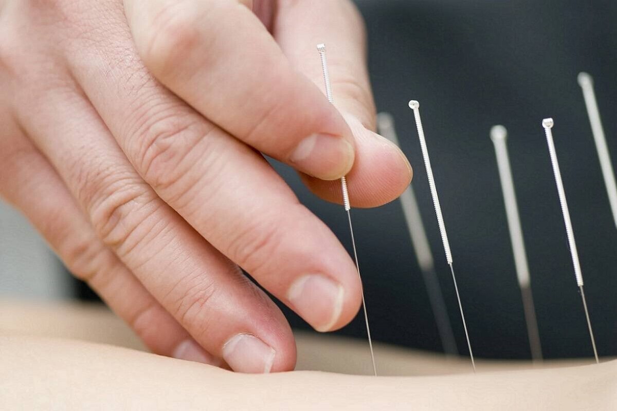 طب سوزنی چه تأثیری در بهبود دیابت دارد؟
