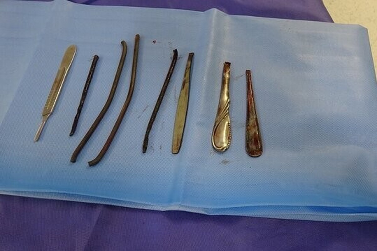 جراحان یکی از مراکز پزشکی فراجا هشت قطعه فلزی از جمله دسته قاشق را از معده فردی که اقدام به بلعیدن آن کرده بود، خارج کردند.