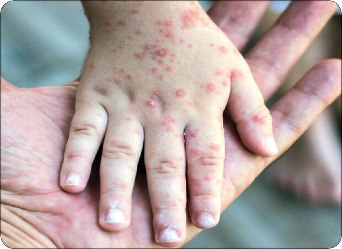 رئیس گروه پیشگیری از بیماری‌های واگیر دانشگاه علوم پزشکی مشهد گفت: از ابتدای سال تاکنون ۲۰۵ نمونه سرخک در آزمایشگاه‌های تحت پوشش دانشگاه علوم پزشکی مشهد گرفته شده که ۲۵ مورد آن‌ها مثبت گزارش شده است.