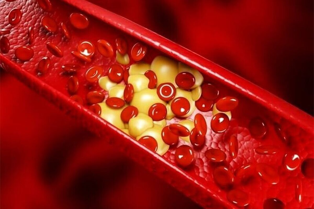 به گفته پزشک متخصص طب سنتی و عضو هیئت‌علمی دانشگاه علوم پزشکی شهید بهشتی، یکی از بیماری‌های شایع جوامع امروزی، بالابودن میزان چربی خون است که می‌تواند منجر به مشکلات جدی مثل پانکراتیت (التهاب پانکراس) و سکته‌های قلبی و حتی مرگ شود.