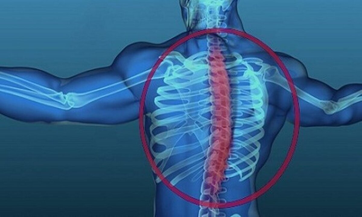 یک جراح مغز و فوق‌تخصص جراحی ستون فقرات دانشگاه علوم پزشکی مشهد گفت: نزدیک به سه درصد از مردم یعنی از هر ۱۰۰ نفر، ۲ تا سه نفر به انحراف جانبی ستون فقرات یا «اسکولیوزیس» مبتلا هستند.