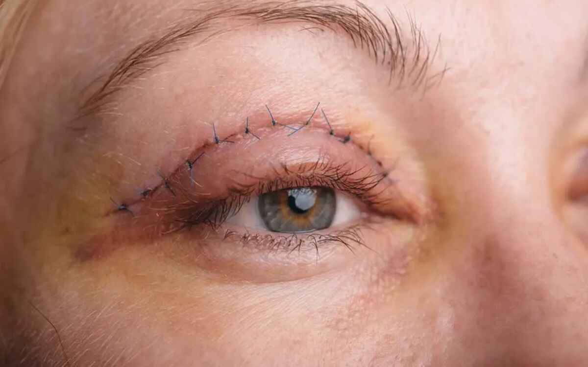 دبیر علمی سمینار جراحی‌های زیبایی و ترمیمی پلک و حدقه با اشاره به افزایش تقاضا برای جراحی‌های زیبایی پلک (بلفاروپلاستی) و لیفت ابرو و پیشانی در سال‌های اخیر، نسبت به عوارض این اقدام زیبایی هشدار داد.
