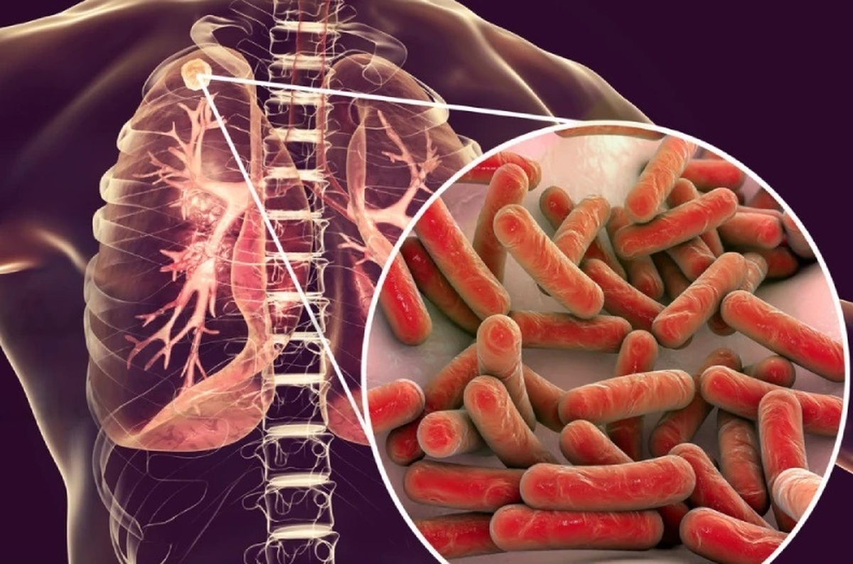 رییس گروه پیشگیری و مدیریت بیماری‌های واگیردار دانشگاه علوم پزشکی مشهد گفت: ۳۰ هزار و ۳۸۲ نفر از جمعیت زیر پوشش این دانشگاه در خراسان رضوی از ابتدای سال جاری تا کنون در زمینه بیماری سل غربالگری شدند که از این تعداد ۴۷۰ بیمار شناسایی شده‌اند و تحت درمان هستند.
