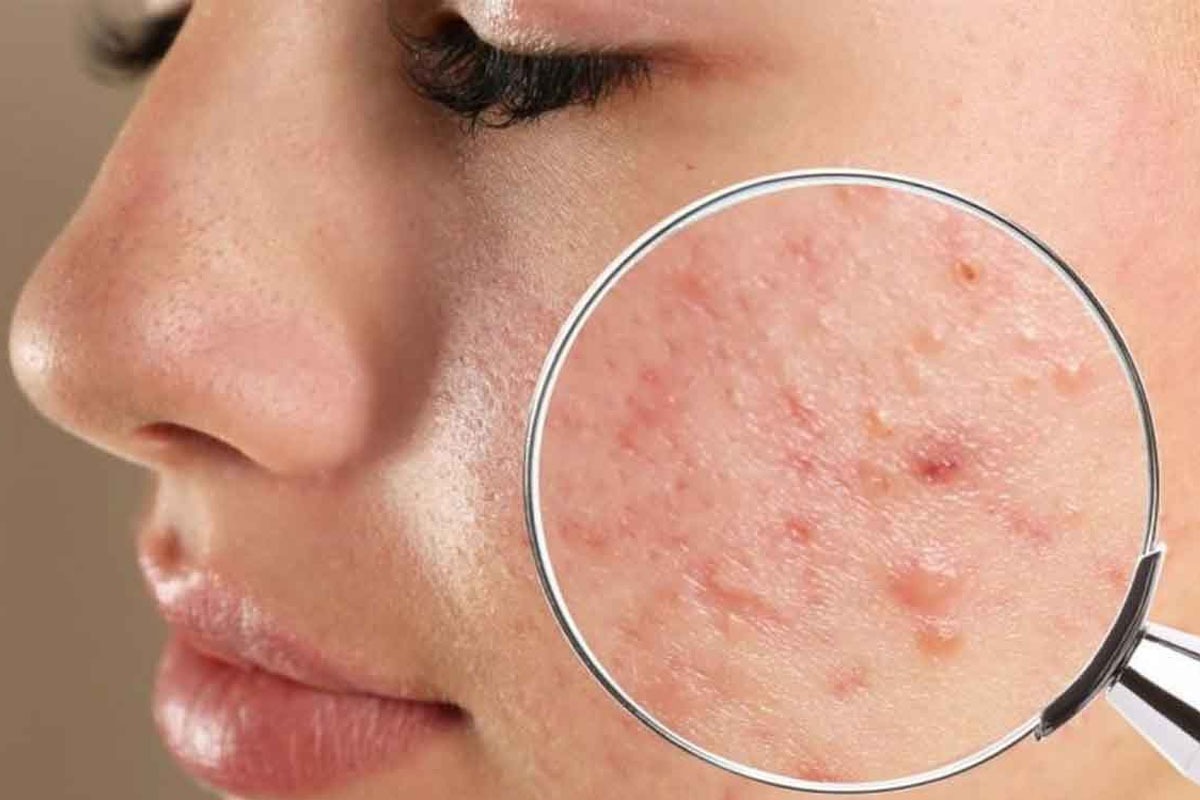 همه چیز درباره آکنه یا جوش‌های پوستی و راه‌های درمان آن | چاله‌چوله‌های پوستی