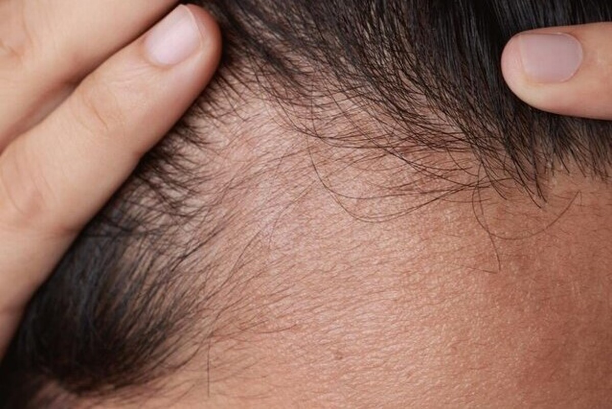روابط عمومی سازمان غذا و دارو در اطلاعیه‌ای، از دستور جمع‌آوری فراورده مکمل تقویتی رشد موی PHYTO خبر داد.