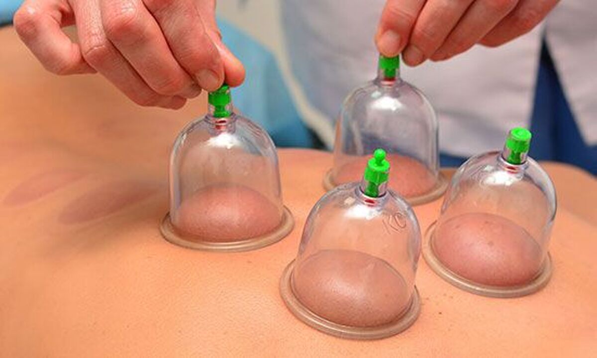 متخصصان طب سنتی می‌گویند حجامت خشک یا بادکش درمانی با استفاده از حرارت یا سرما به شکل خونگیری انجام نمی‌شود و روشی رایج در دنیاست که برای کودکان انجام می‌شود.
