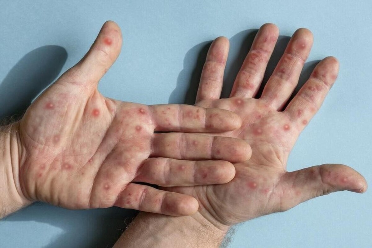 فوق تخصص مراقبت‌های ویژه و عضو هیئت علمی دانشکده علوم پزشکی دانشگاه شهید بهشتی گفت: انتقال آبله میمونی در مواردی که افراد در یک مکان و در ارتباط نزدیک با هم باشند اتفاق می‌افتد.