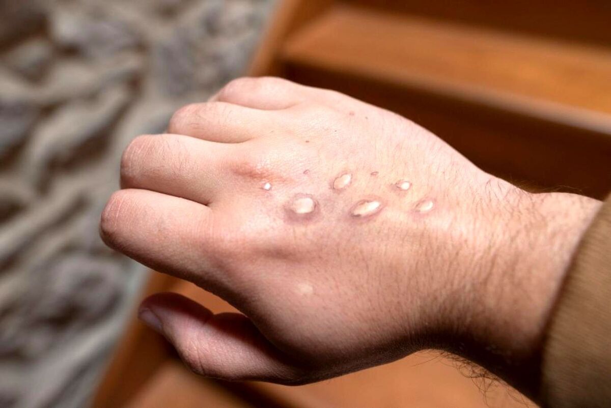 سرپرست دفتر آموزش و ارتقاء سلامت وزارت بهداشت گفت: موارد مشکوکی در هفته‌های گذشته توسط پزشکان اعلام شد که بررسی همه موارد با دقت در آزمایشگاه ملی کشور انجام شد و همگی از نظر آبله میمونی منفی بودند.
