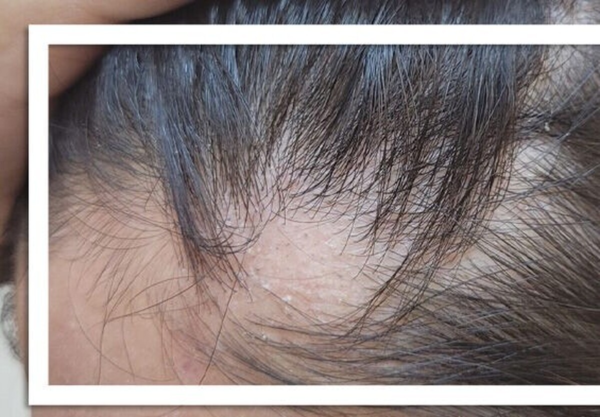 اگر بدن شما به فولیکول‌های مو حمله کرده و باعث ریزش مو سکه‌ای شده است، احتمالاً حاضرید هر درمانی را امتحان کنید!