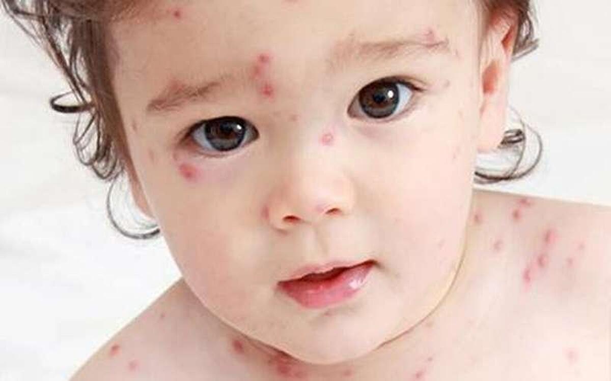 آبله مرغان برای چه افرادی خطرناک است؟