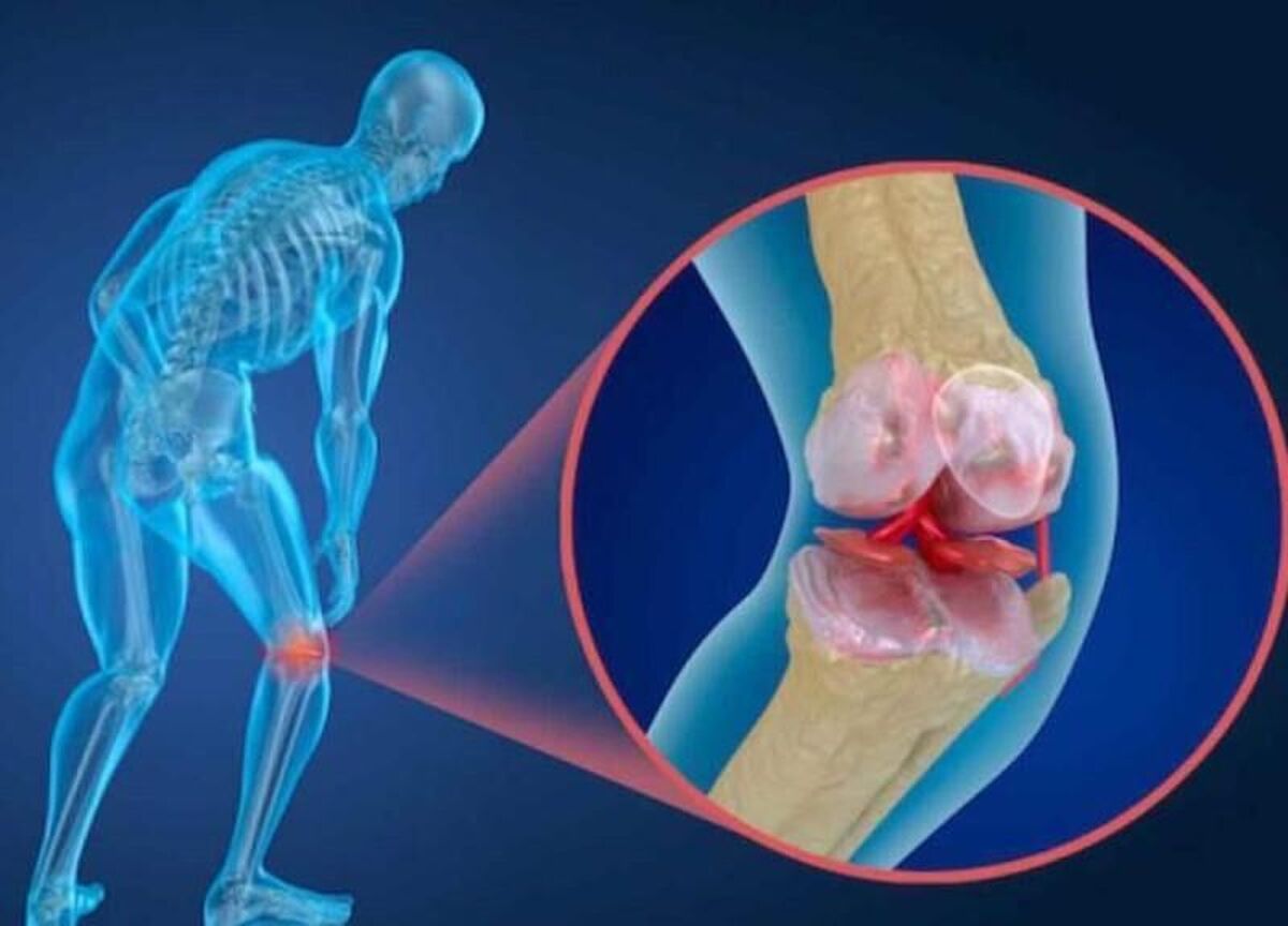 یک تمرین ساده برای تسکین زانودرد