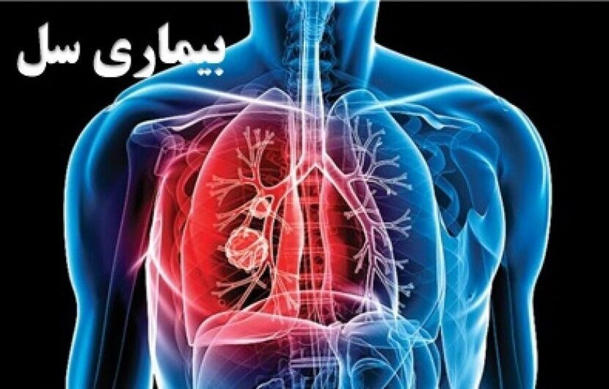 رییس گروه پیشگیری و مبارزه با بیماری‌های واگیر دانشگاه علوم پزشکی مشهد گفت: ۷۳۸ بیمار مبتلا به سل در مناطق زیر پوشش دانشگاه‌های علوم پزشکی مشهد و نیشابور طی سال گذشته شناسایی شدند و تحت درمان قرار گرفتند.