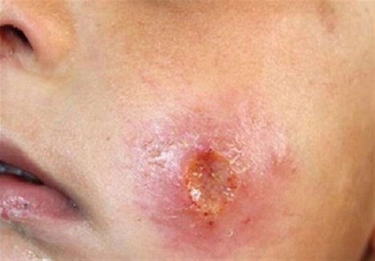 رئیس گروه پیشگیری از بیماری‌های واگیردار معاونت بهداشتی دانشگاه علوم پزشکی مشهد اظهار کرد: ۹ مرکز درمان سالک در مناطق مختلف بهداشتی مشهد فعال و آماده ارائه خدمت به مراجعین در ایام نوروز ۱۴۰۴ هستند. 