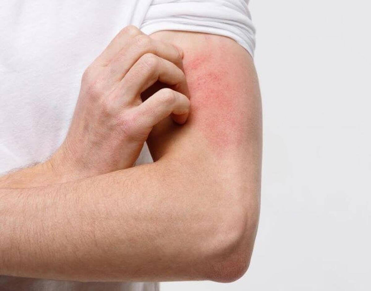 یک متخصص پوست، مو و زیبایی و عضو هیئت‌علمی دانشگاه علوم پزشکی همدان گفت: عوامل مختلفی می‌توانند موجب تحریک حساسیت در این بیماران شوند، یکی از این عوامل تغییرات فصلی است؛ به‌گونه‌ای‌که آغاز فصل بهار و گرده‌افشانی گل‌ها می‌تواند موجب تشدید علائم شود.